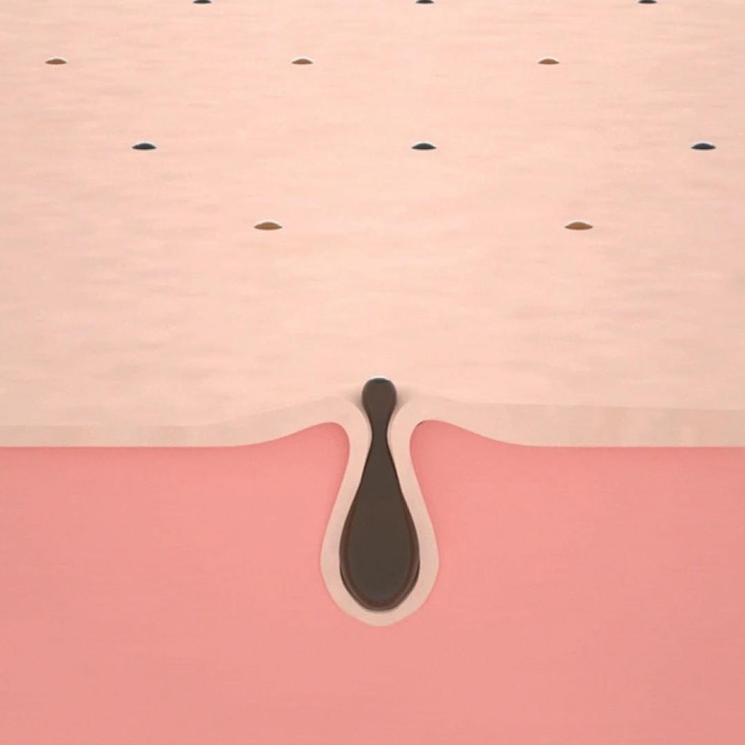 Электрический очиститель угрей Xiaomi Wellskins Electric Blackhead Cleaner (WX-HT100)