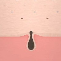 Электрический очиститель угрей Xiaomi Wellskins Electric Blackhead Cleaner (WX-HT100)